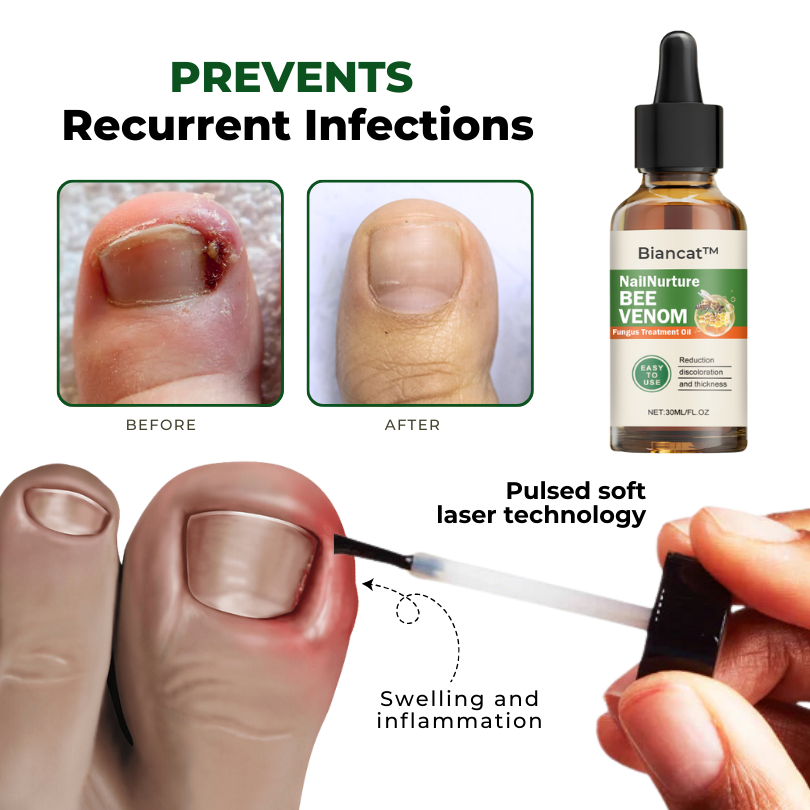 Biancat™ NailNurture Olej na léčbu plísní včelím jedem -👨⚕️ Schválila Americká dermatologická akademie (AAD)