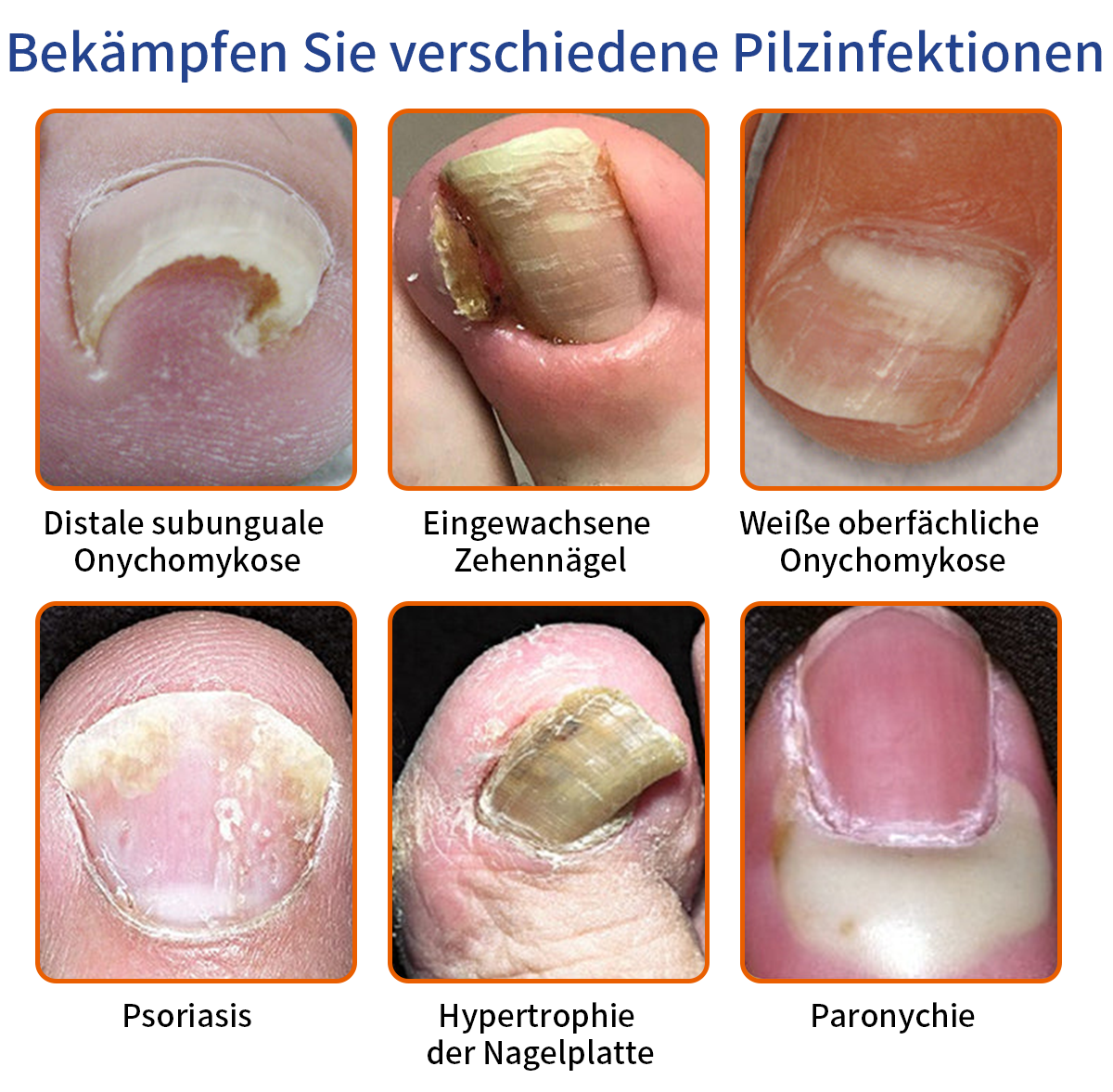 🐝🐝Furzero™ řešení léčby plísně nehtů včelím jedem:Úplně vyřeší problém s plísní nehtů🌟👣