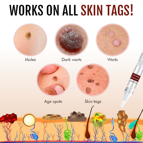 ⭐WipeOff™ Tags & Moles Remover